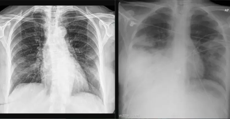 Datascience:COVID-19 Pneumonia Classification(Deep learning)